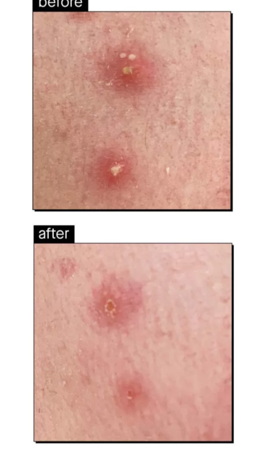 Before and after comparison of skin with Dryzit Acenemy lotion displayed.