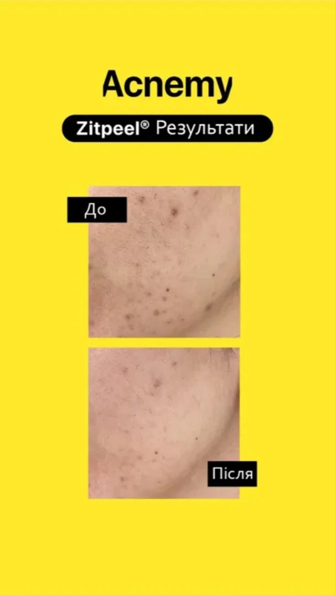 Кислотний незмивний пілінг для шкіри схильної до акне Zitpeel, Acnemy