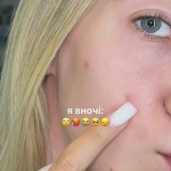 Локальний засіб від прищів підсушуючий Anti-Pimple Drying lotion 10ml, Recare