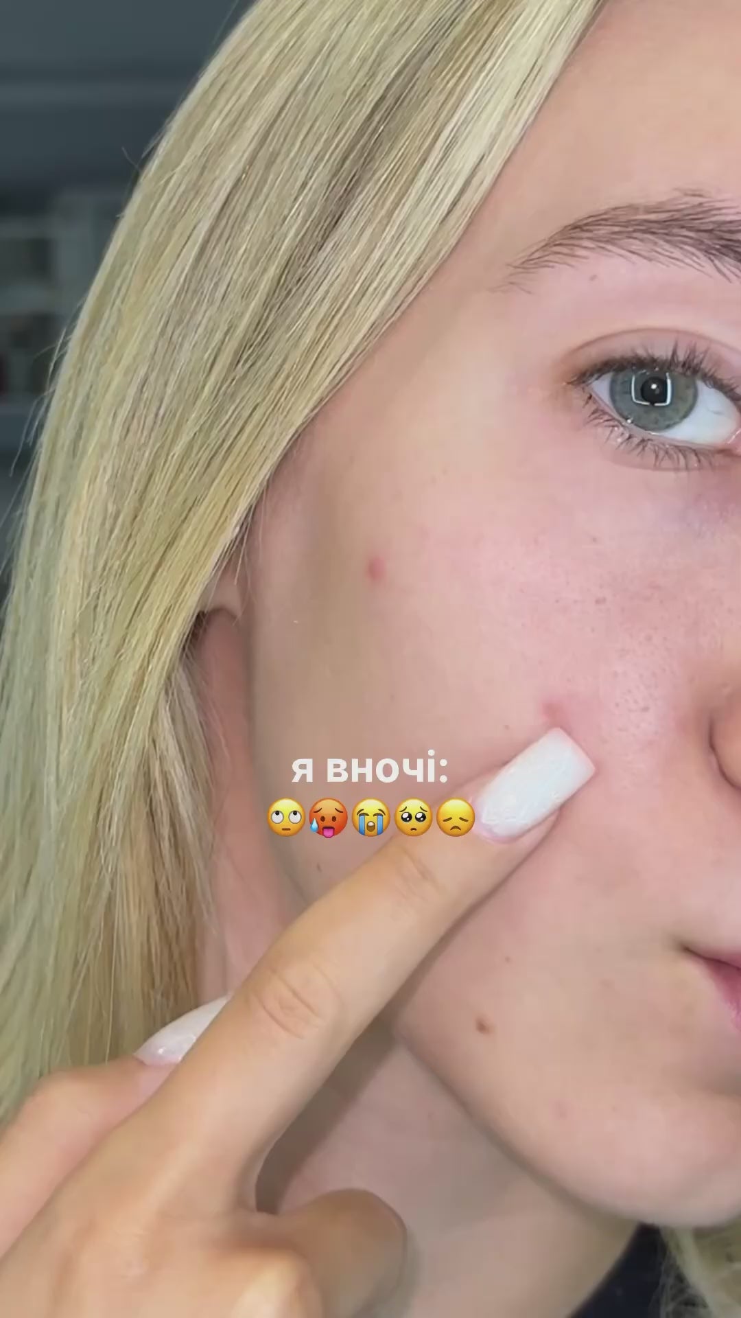 Локальний засіб від прищів підсушуючий Anti-Pimple Drying lotion 10ml, Recare