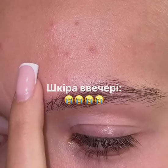 Локальний засіб від прищів підсушуючий Anti-Pimple Drying lotion 10ml, Recare