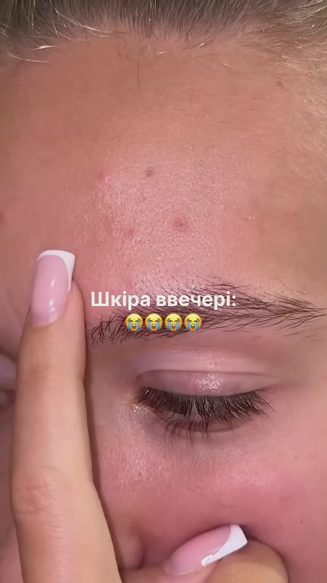 Локальний засіб від прищів підсушуючий Anti-Pimple Drying lotion 10ml, Recare